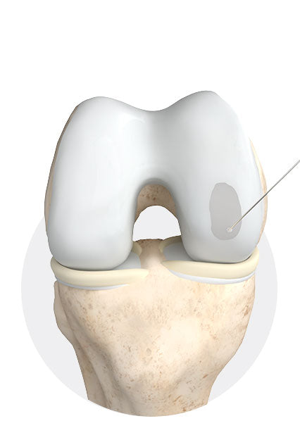 Inject collagen matrix